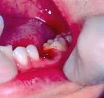tooth bleed