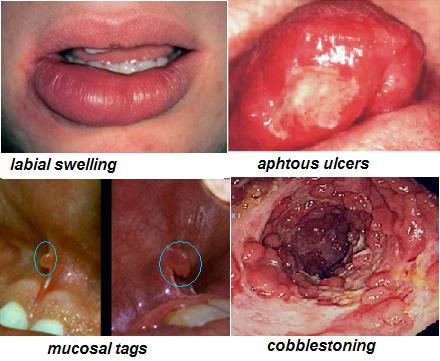 Oral manifestations of Crohn disease